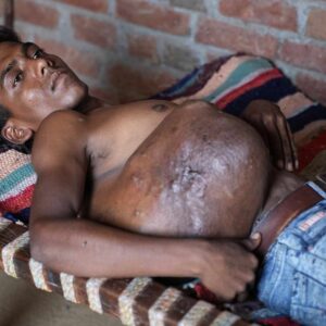 A Massive Tumour Has Left This 23-Year-Old Yearning For A Normal Life