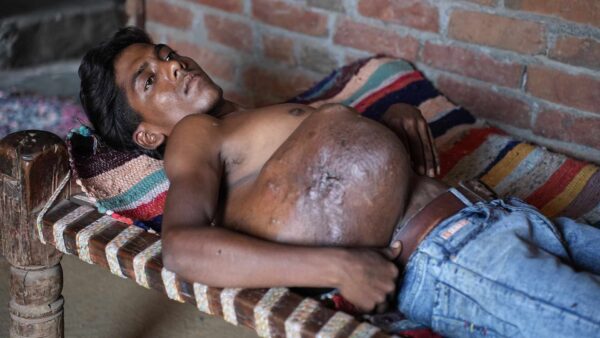 A Massive Tumour Has Left This 23-Year-Old Yearning For A Normal Life